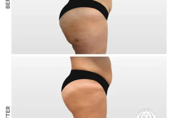 La Liposuzione: Procedura, Vantaggi e Rischi