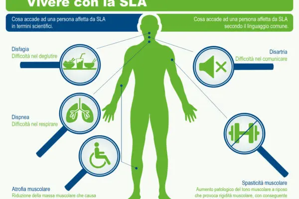 SLA Malattia: La Sclerosi Laterale Amiotrofica in Focus