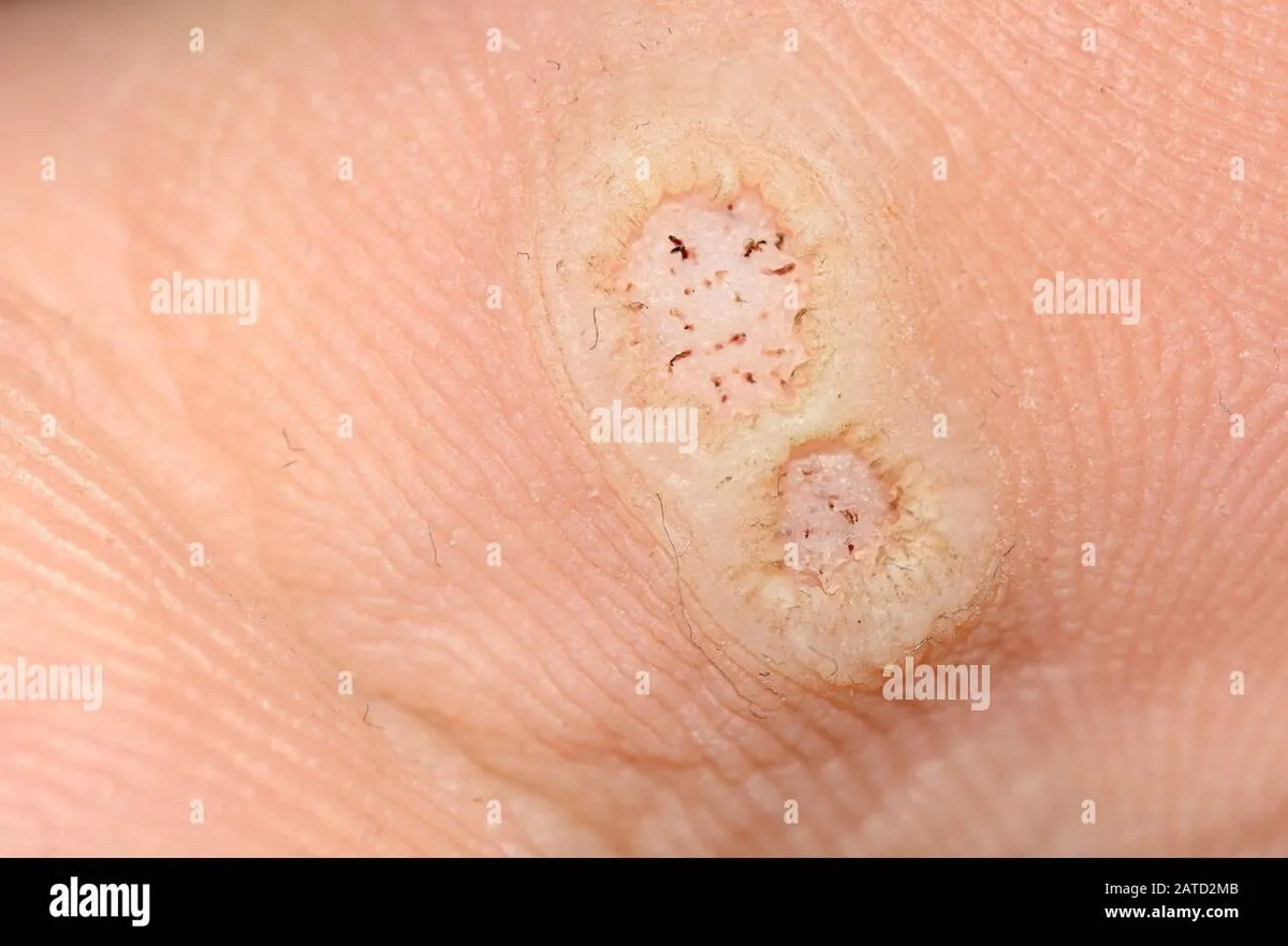 papilloma virus — IT news