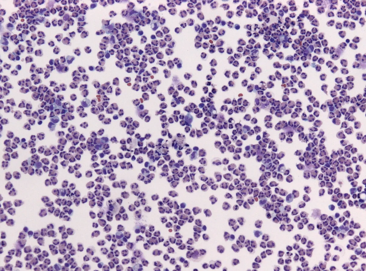 Meningite fulminante pescara: Meningite fulminante a Pescara: cosa è successo?